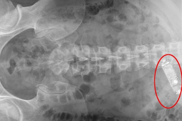 Foto - Ameliyatlarda hastaların içinde unutulan enteresan şeyler!