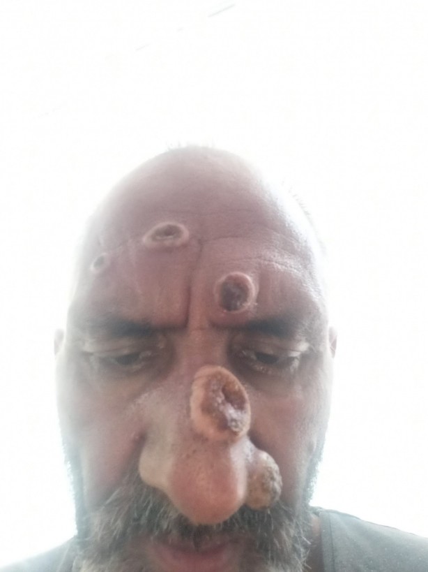 Antalya'ya çalışmaya giden işçinin hayatı sinek ısırması ile kabusa döndü!