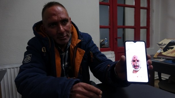 Foto - Antalya'ya çalışmaya giden işçinin hayatı sinek ısırması ile kabusa döndü!