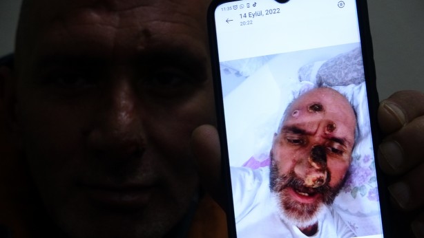 Foto - Antalya'ya çalışmaya giden işçinin hayatı sinek ısırması ile kabusa döndü!