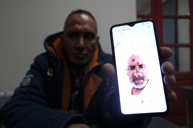 Foto - Antalya'ya çalışmaya giden işçinin hayatı sinek ısırması ile kabusa döndü!