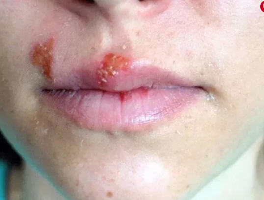 Foto - Antibiyotik almaya son! İşte iltihaba meydan okuyan bitki