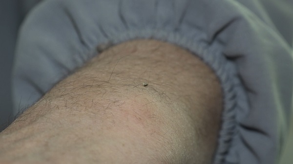 Foto - Arılarla şifa buluyorlar! Bu yöntem 5 bin yıldır kullanılıyor