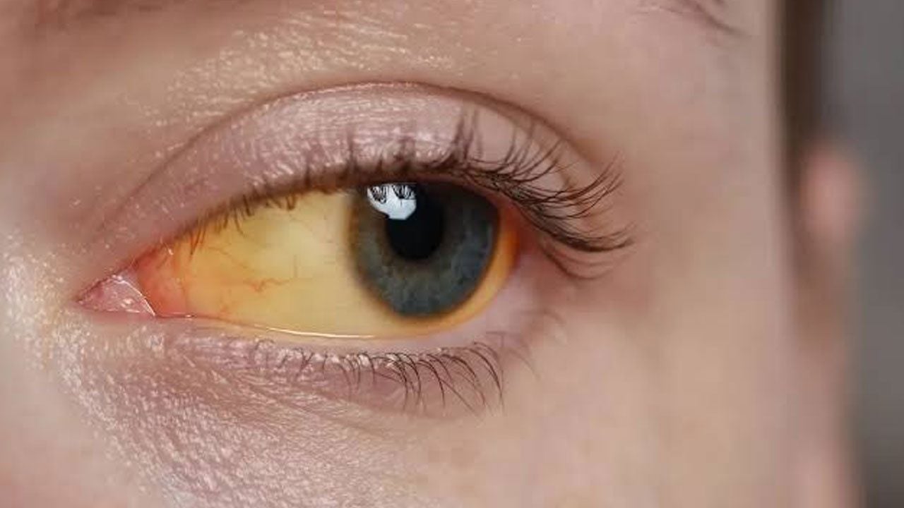 Arkasında ciddi bir hastalık yatıyor olabilir! Gözlerdeki bu belirtiyi hafife almayın