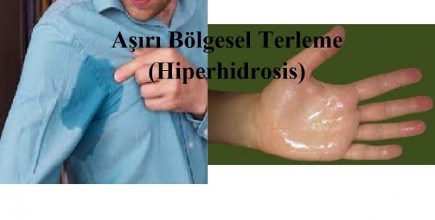 Foto - Aşırı terleme neyin habercisi? Aşırı terlemeyi ne tetikler? Tedavisi var mıdır?