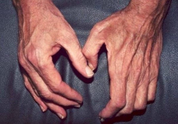 Foto - Aşırı terleme tiroid hastalığı belirtisi!