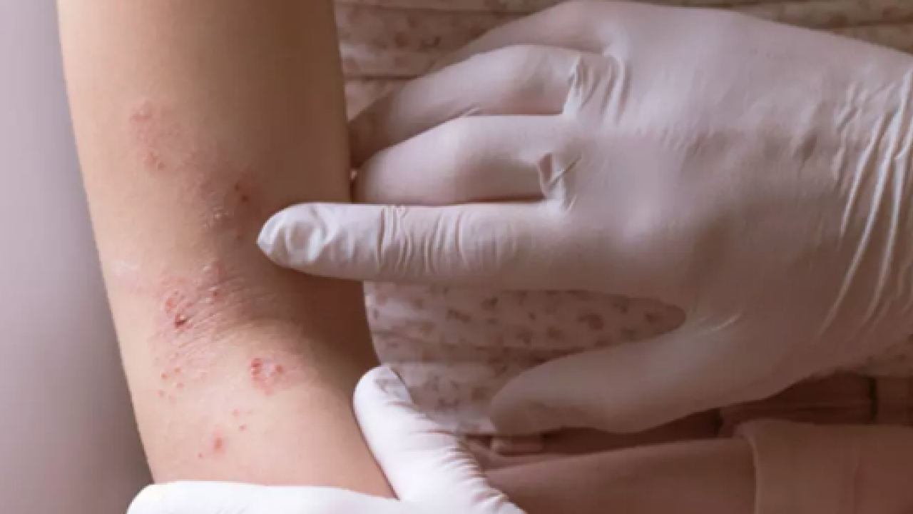 Atopik dermatit vakaları... Egzaması olan bebekler için ciddi önlem alınmalı...