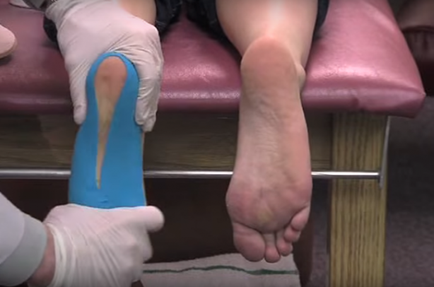 Foto - Ayağınızdaki ağrının sebebi topuk dikeni olabilir!