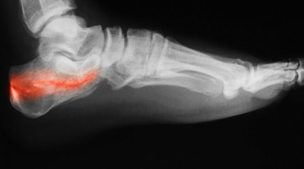 Foto - Ayağınızdaki ağrının sebebi topuk dikeni olabilir!