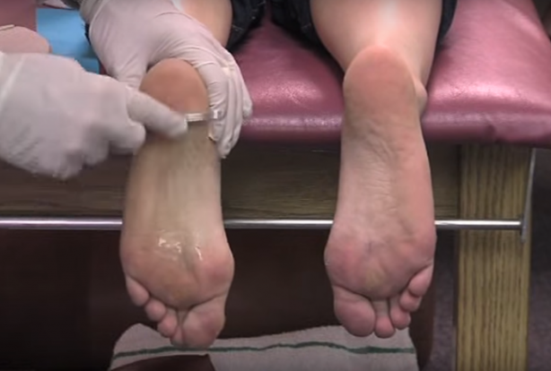 Foto - Ayağınızdaki ağrının sebebi topuk dikeni olabilir!