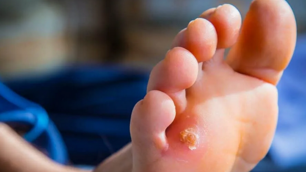 Foto - Ayak bakım suyuna 1 kaşık ekleyin! Yorgunluğu, nasırı ve kötü kokuyu sıfırlıyor