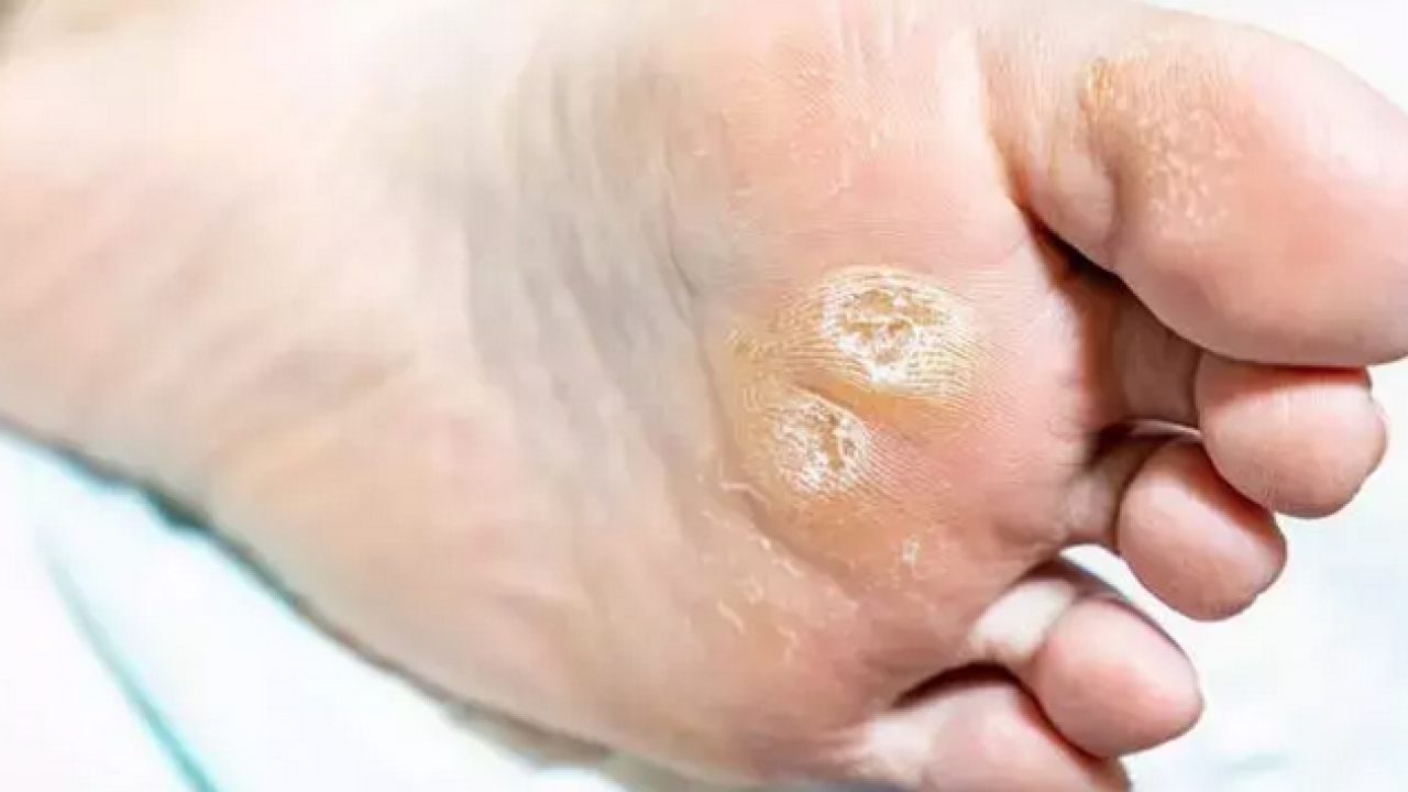 Foto - Ayak bakım suyuna 1 kaşık ekleyin! Yorgunluğu, nasırı ve kötü kokuyu sıfırlıyor