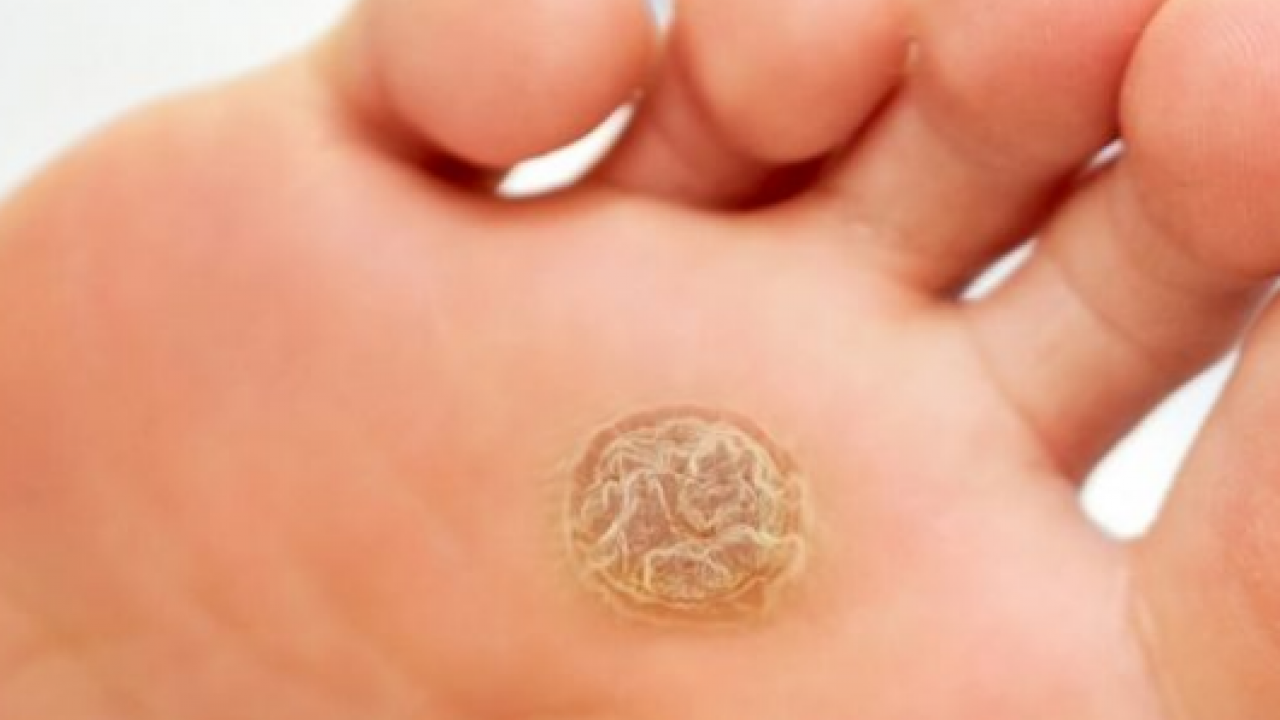 Foto - Ayak bakım suyuna 1 kaşık ekleyin! Yorgunluğu, nasırı ve kötü kokuyu sıfırlıyor