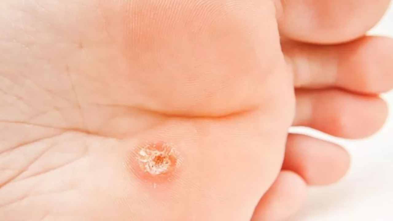 Foto - Ayak bakım suyuna 1 kaşık ekleyin! Yorgunluğu, nasırı ve kötü kokuyu sıfırlıyor