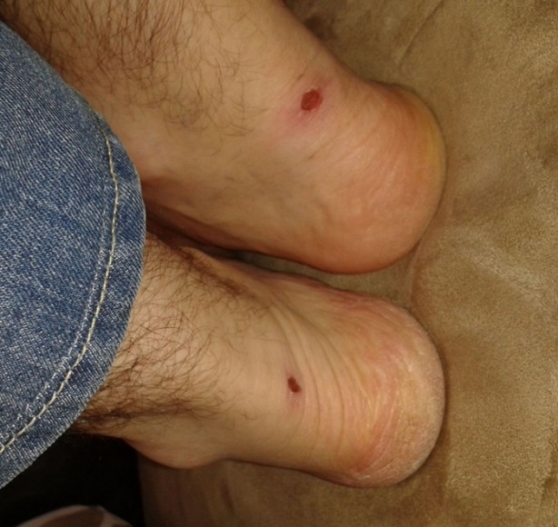 Foto - Ayakkabı vurmasını böyle engelleyin