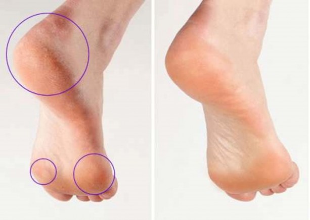 Foto - Ayakkabı vurmasını böyle engelleyin