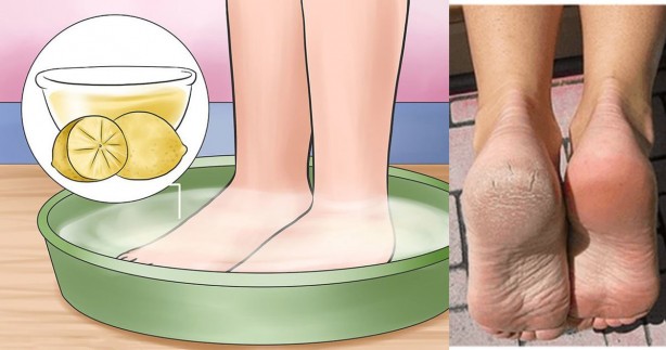 Foto - Ayaklardaki nasırları yok edecek en etkili yöntem: Yeniden güçlendirilmeli! Nasırı kökünden söken destek 