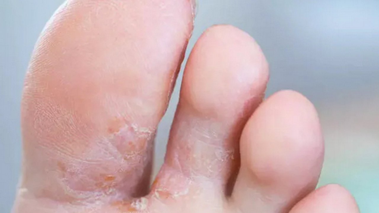 Foto - Ayaklarınıza ondan sürün, ne mantar kalsın ne de nasır: Su serpin! Bu yağ doğal şifa kaynağı