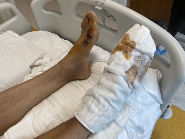 Az daha ayağını kaybediyordu! Bu ürünü kullananlar dikkat!