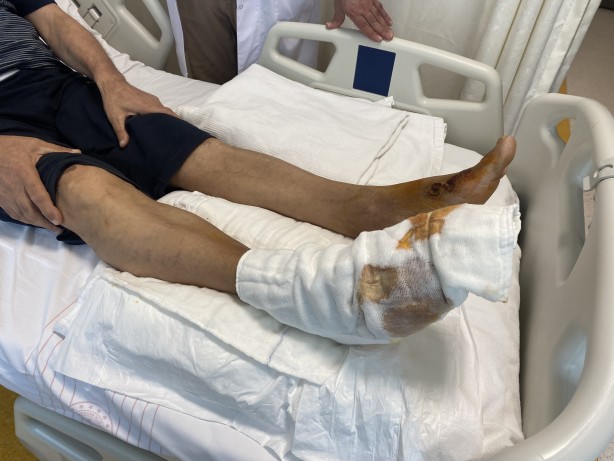 Foto - Az daha ayağını kaybediyordu! Bu ürünü kullananlar dikkat!