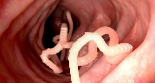 Foto - Bağırsak Kurduna doğal çözümler! Bağırsak temizleme nasıl yapılır? Merak ediyorsanız İşte o yöntem, artık olmayacak