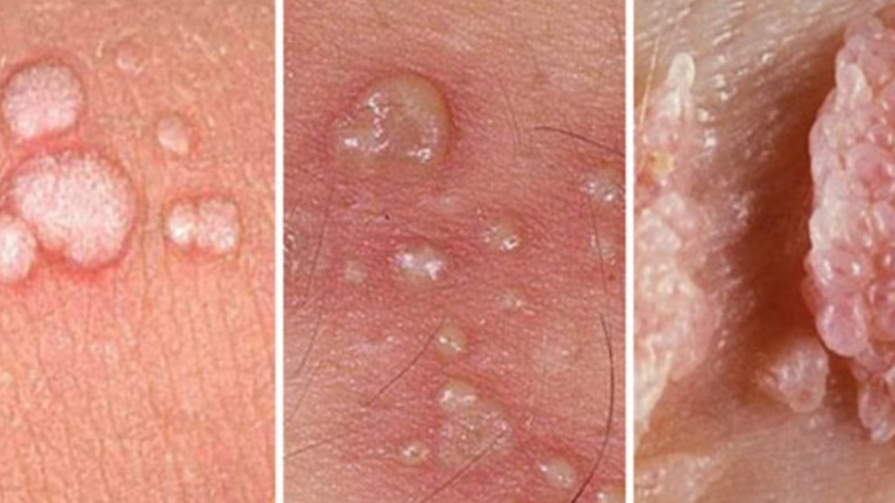 Foto - Baş-Boyun kanserlerinde de risk faktörü: HPV aşısı başvuruları devam ediyor 