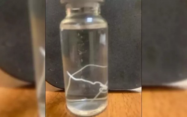 Foto - Başı ağrıyan hastanın alnından çıkan canlı yok artık dedirtti!