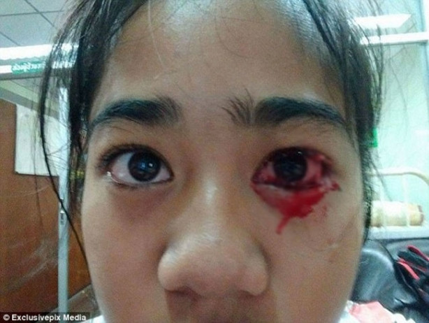 Foto - Başı ağrıyınca gözlerinden kan geliyor!