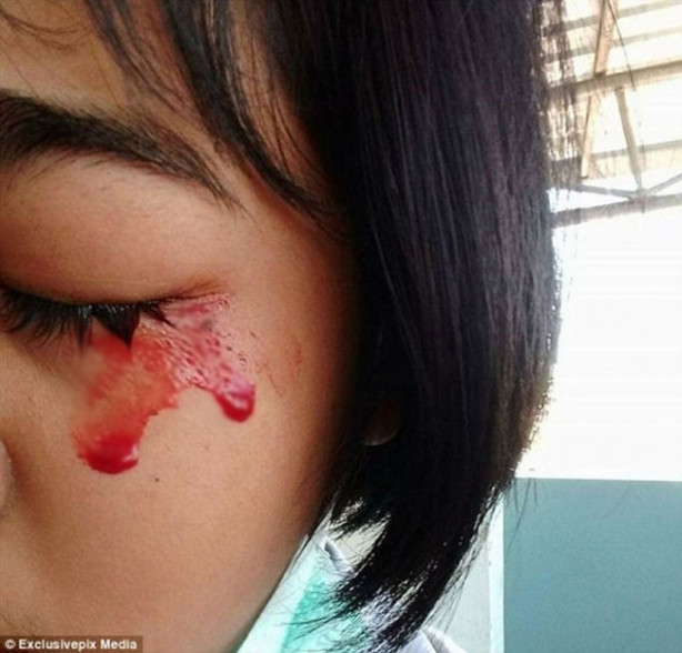  Başı ağrıyınca gözlerinden kan geliyor!