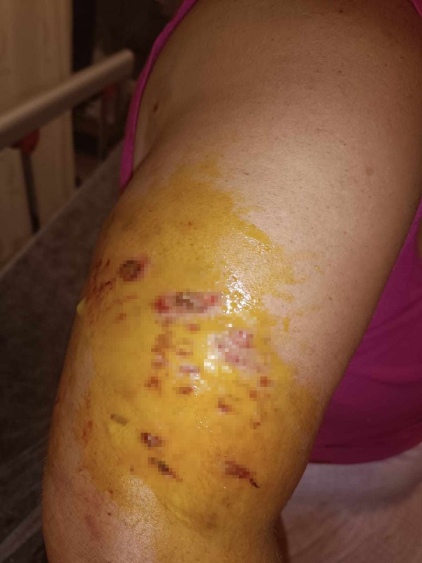 Foto - Başıboş köpekler saldırmıştı! Tek başına sokağa çıkamıyor