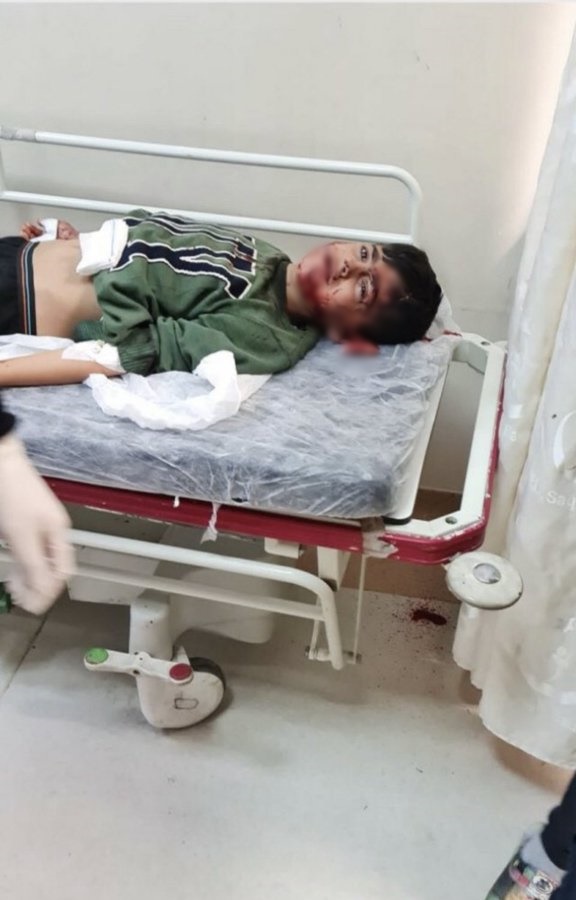 Başıboş köpeklerin 7 yaşındaki çocuğu ağır yaralamasının ardından vatandaşlar ayağa kalktı!