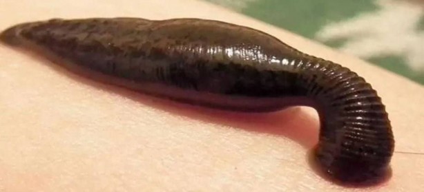 Foto - Basit bir boğaz ağrısı zannetti, boğazından çıkan canlı hayrete düşürdü! Kanla besleniyor, ölümden döndü