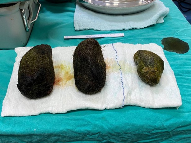 Foto - Basit bir karın ağrısı zannetti, midesinden tam iki kilo kıl çıktı! Sebebi, duyanları şaşkına çevirdi