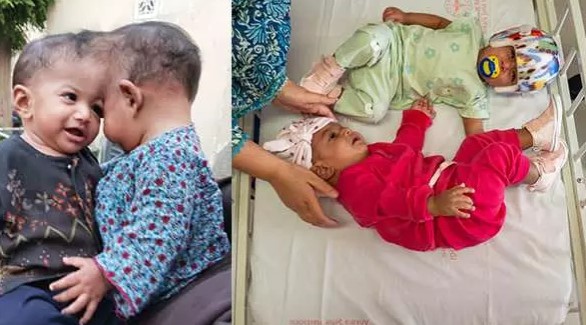 Foto - Başkan Erdoğan talimat vermişti! Pakistanlı yapışık ikizler birbirinden ayrıldı