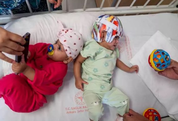 Foto - Başkan Erdoğan talimat vermişti! Pakistanlı yapışık ikizler birbirinden ayrıldı