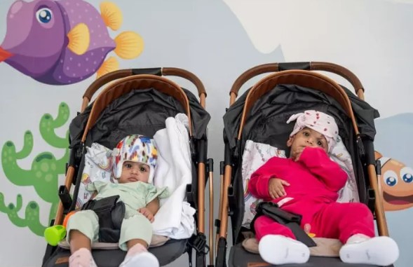 Foto - Başkan Erdoğan talimat vermişti! Pakistanlı yapışık ikizler birbirinden ayrıldı