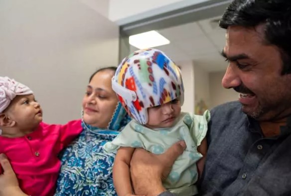 Foto - Başkan Erdoğan talimat vermişti! Pakistanlı yapışık ikizler birbirinden ayrıldı