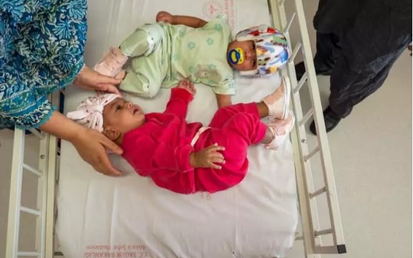 Foto - Başkan Erdoğan talimat vermişti! Pakistanlı yapışık ikizler birbirinden ayrıldı