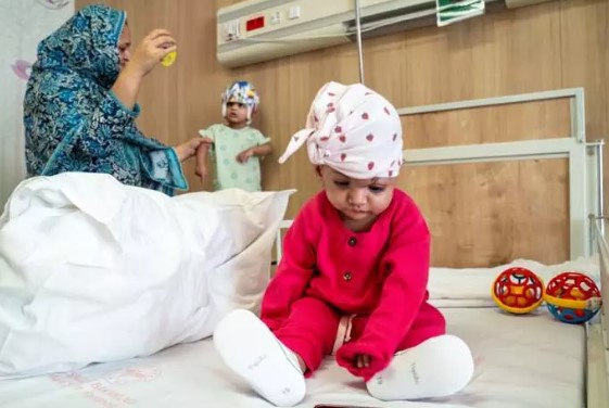 Foto - Başkan Erdoğan talimat vermişti! Pakistanlı yapışık ikizler birbirinden ayrıldı