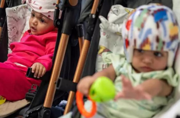 Foto - Başkan Erdoğan talimat vermişti! Pakistanlı yapışık ikizler birbirinden ayrıldı