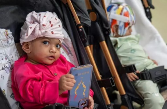 Foto - Başkan Erdoğan talimat vermişti! Pakistanlı yapışık ikizler birbirinden ayrıldı