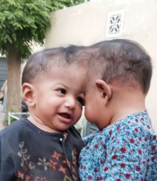 Foto - Başkan Erdoğan talimat vermişti! Pakistanlı yapışık ikizler birbirinden ayrıldı