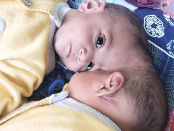 Foto - Başkan Erdoğan talimat vermişti! Pakistanlı yapışık ikizler birbirinden ayrıldı