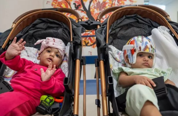 Başkan Erdoğan talimat vermişti! Pakistanlı yapışık ikizler birbirinden ayrıldı