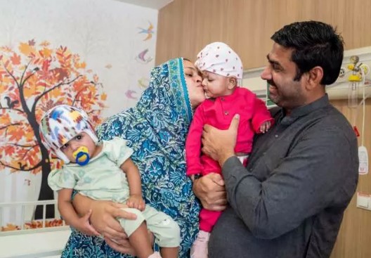 Foto - Başkan Erdoğan talimat vermişti! Pakistanlı yapışık ikizler birbirinden ayrıldı