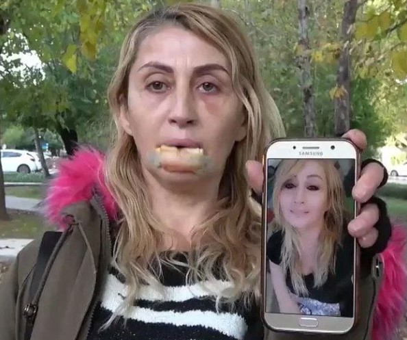 Foto - Batılı yaşam tarzının son eseri: Güzellik uğruna dudağından oldu!