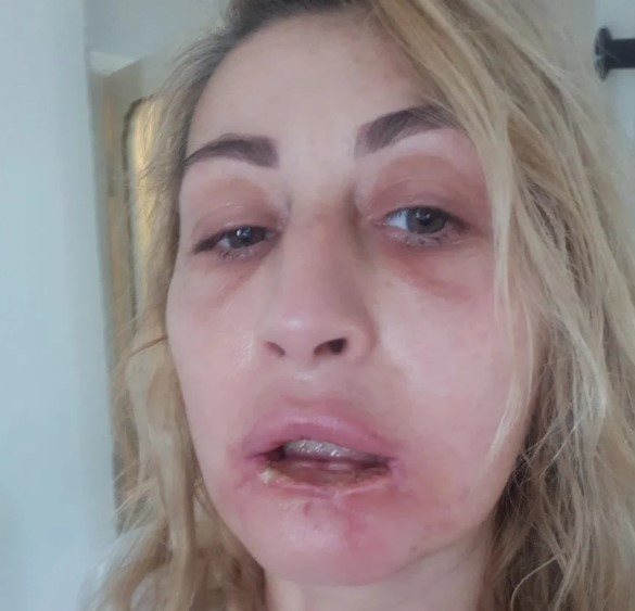 Foto - Batılı yaşam tarzının son eseri: Güzellik uğruna dudağından oldu!