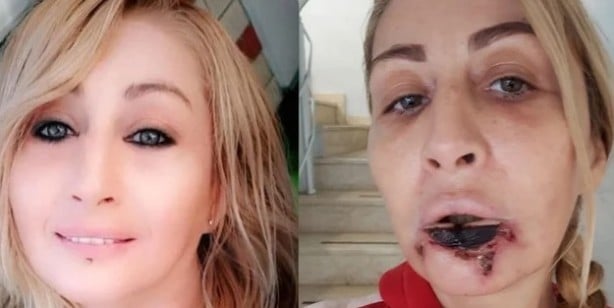 Batılı yaşam tarzının son eseri: Güzellik uğruna dudağından oldu!