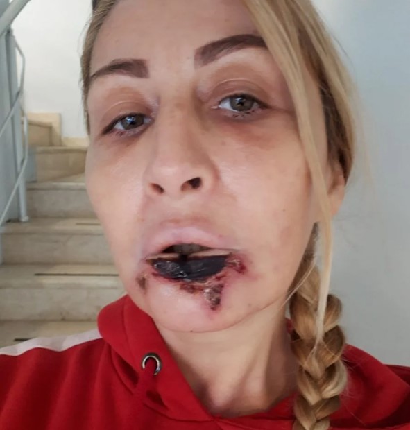 Foto - Batılı yaşam tarzının son eseri: Güzellik uğruna dudağından oldu!