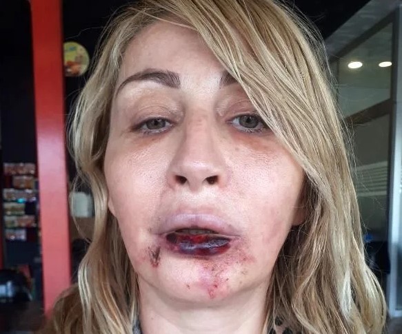Foto - Batılı yaşam tarzının son eseri: Güzellik uğruna dudağından oldu!